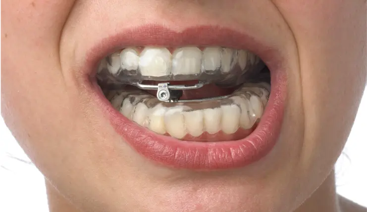 Nahaufnahme eines Mundes in Bad Soden mit transparenten Zahnschienen und einer Metallklammer zur Kieferkorrektur.