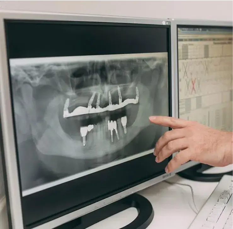 Nahaufnahme eines Röntgenbilds auf einem Monitor, das Zahnimplantate im Unterkiefer zeigt. Ein Zahnarzt zeigt auf die Röntgenaufnahme während der Implantatbehandlungsplanung in der Zahnarztpraxis in Bad Soden.